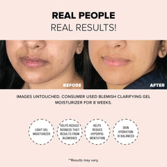 Blemish Clarifying Gel Moisturizer
